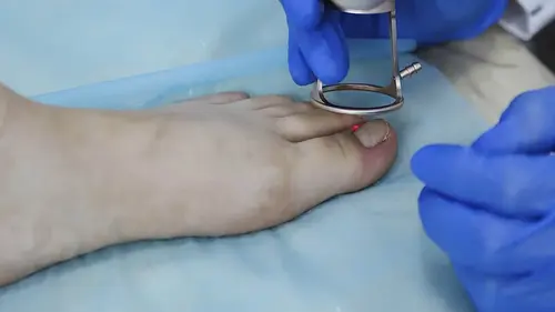 borttagning av ingrodd tånagel