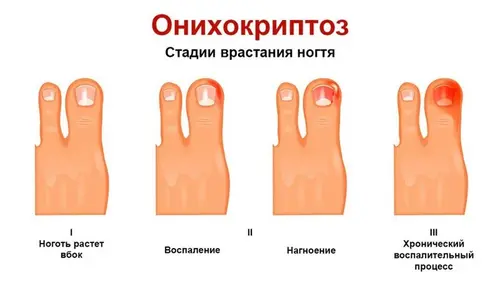 Onykokryptos stadier av nagelns inväxning